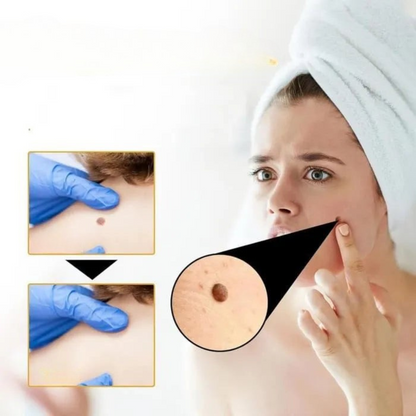 Recede™ Verrugas Fuera, Piel Limpia - [PROMOCIÓN DISPONIBLE SOLO HOY]